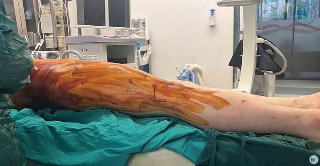 A Painful Path to Perfection: The Grueling Reality of Height-Enhancing Surgery in the UK