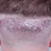 Black Market Hair Transplants Flourish Due to Regulatory Gaps, Public Health at Risk
