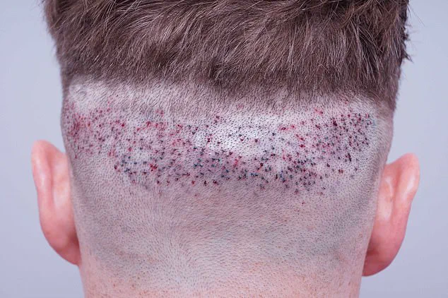 Black Market Hair Transplants Flourish Due to Regulatory Gaps, Public Health at Risk