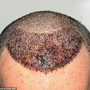 Conveyor Belt Clinics in Turkey: Dallas Surgeon Exposes Tragic Consequences of Botched Hair Transplants