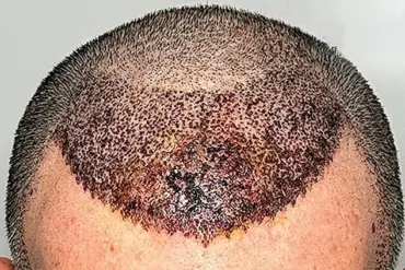 Conveyor Belt Clinics in Turkey: Dallas Surgeon Exposes Tragic Consequences of Botched Hair Transplants