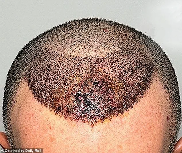 Conveyor Belt Clinics in Turkey: Dallas Surgeon Exposes Tragic Consequences of Botched Hair Transplants