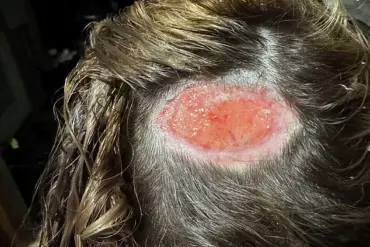 North Carolina Teen Suffers Scalp Burn After Hair Dye Mishap
