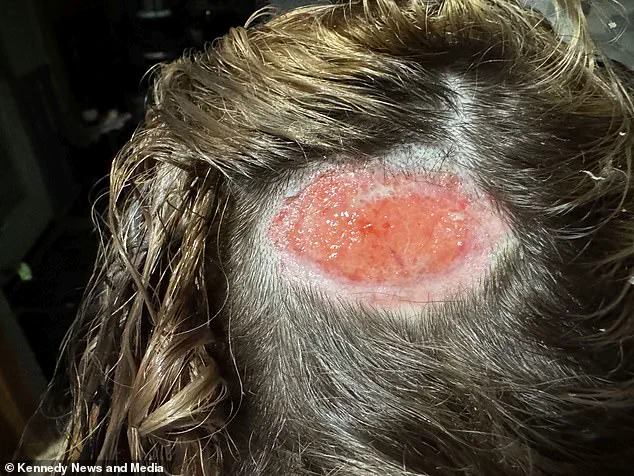 North Carolina Teen Suffers Scalp Burn After Hair Dye Mishap