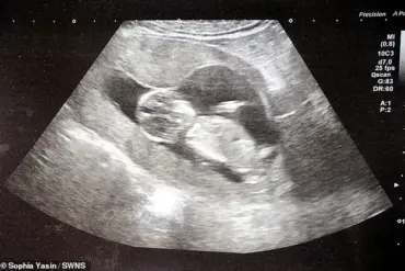Rare Cancer Diagnosis During Pregnancy: A Mother's Unforeseen Journey