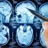 Study Suggests Link Between Traumatic Brain Injuries and Increased Risk of Brain Tumors