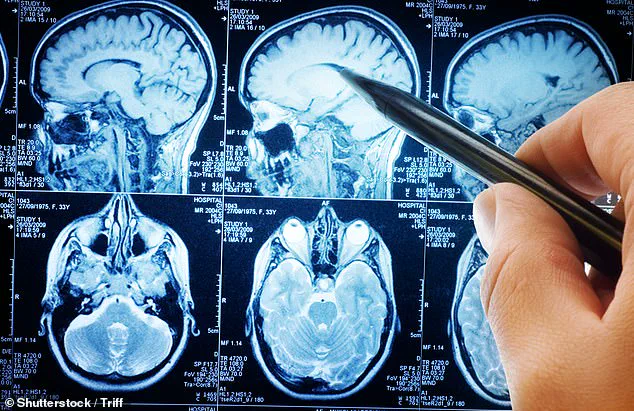 Study Suggests Link Between Traumatic Brain Injuries and Increased Risk of Brain Tumors