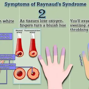 Experts Hail Potential Cure for Raynaud's Disease, Affecting Up to 30 Million Americans