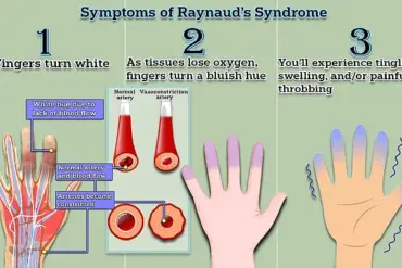 Experts Hail Potential Cure for Raynaud's Disease, Affecting Up to 30 Million Americans