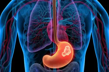 Undetected Oesophageal Cancer in A&E: The Consequences of Delayed Diagnosis