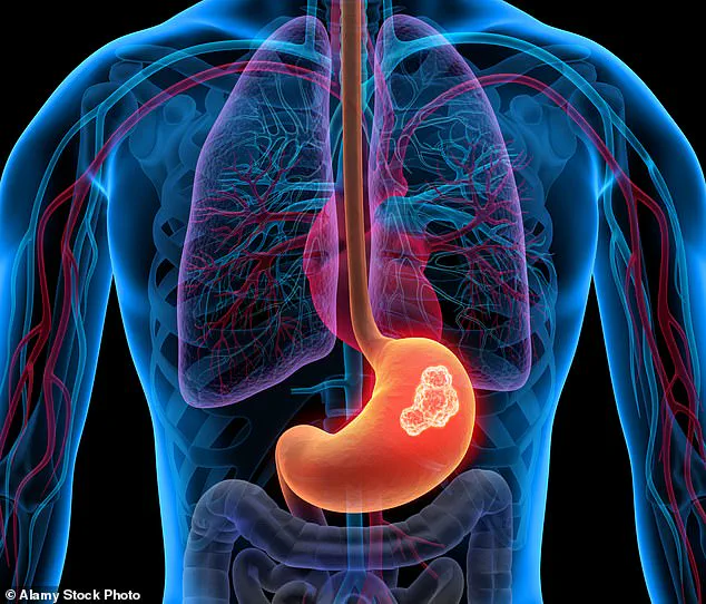 Undetected Oesophageal Cancer in A&E: The Consequences of Delayed Diagnosis